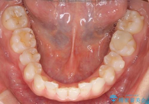 【インビザライン】前歯のねじれを治したいの治療中