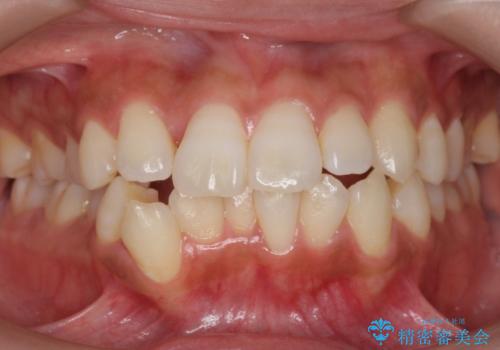 犬歯が歯ぐきにうまっている 真ん中のずれ、出っ歯を治したいの症例 治療前