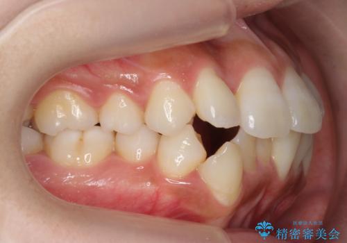 犬歯が歯ぐきにうまっている　真ん中のずれ、出っ歯を治したいの治療前