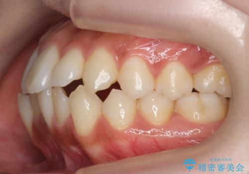 犬歯が歯ぐきにうまっている　真ん中のずれ、出っ歯を治したいの治療前