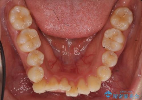 犬歯が歯ぐきにうまっている 真ん中のずれ、出っ歯を治したいの治療前