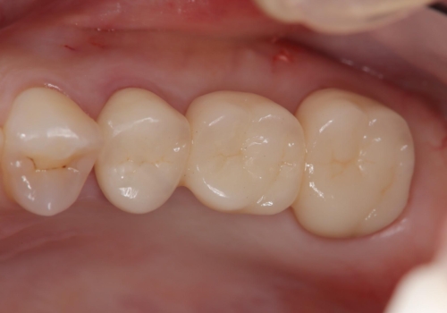 メタルフリー治療 保険の金属ブリッジから、自費のセラミックブリッジへの治療後