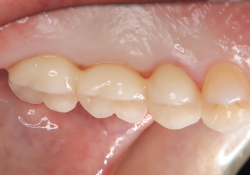 メタルフリー治療 保険の金属ブリッジから、自費のセラミックブリッジへの治療後