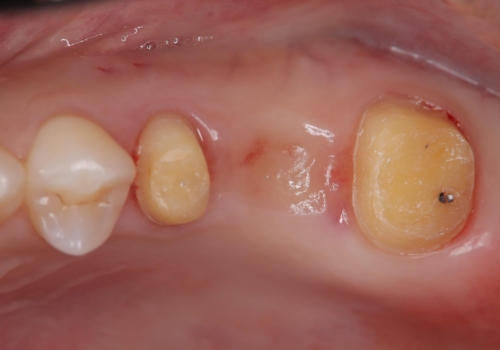 メタルフリー治療 保険の金属ブリッジから、自費のセラミックブリッジへの治療中