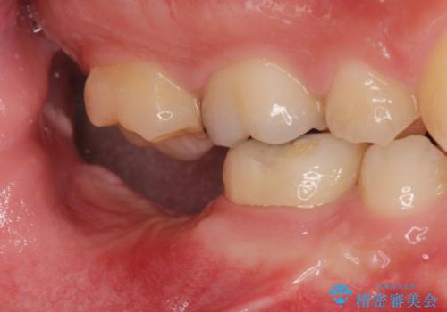 銀歯を白くしたい。(インプラント治療)の治療前