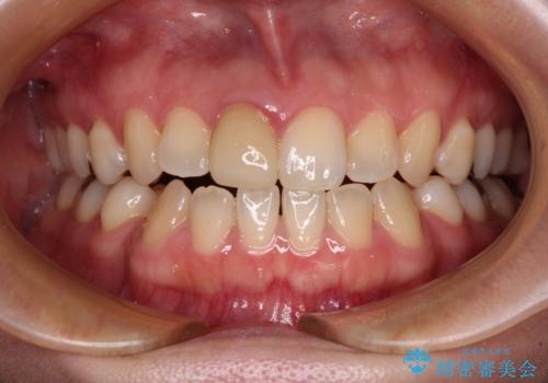 【モニター】後戻りでできた隙間 ワイヤー装置での再矯正の症例 治療前