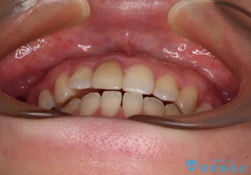 【モニター】後戻りでできた隙間 ワイヤー装置での再矯正の治療前