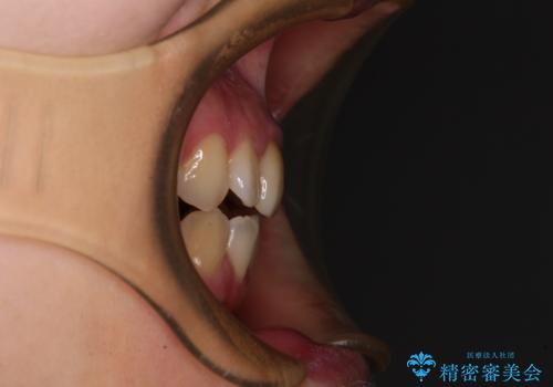 【モニター】後戻りでできた隙間 ワイヤー装置での再矯正の治療前