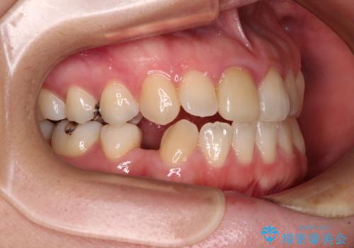 【モニター】後戻りでできた隙間 ワイヤー装置での再矯正の治療前