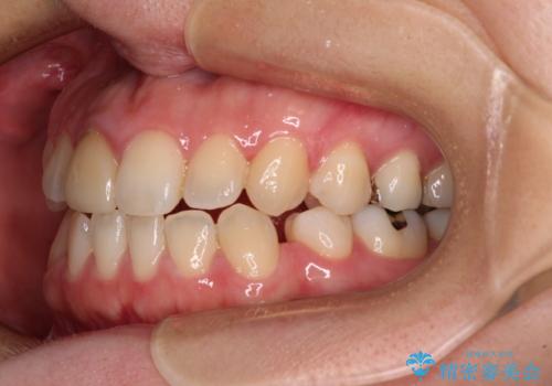 【モニター】後戻りでできた隙間 ワイヤー装置での再矯正の治療前