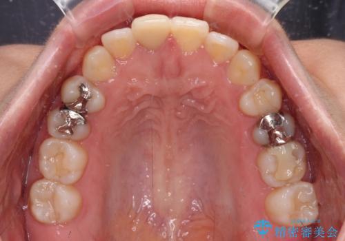 【モニター】後戻りでできた隙間 ワイヤー装置での再矯正の治療前