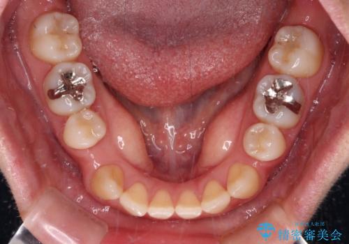 【モニター】後戻りでできた隙間 ワイヤー装置での再矯正の治療前