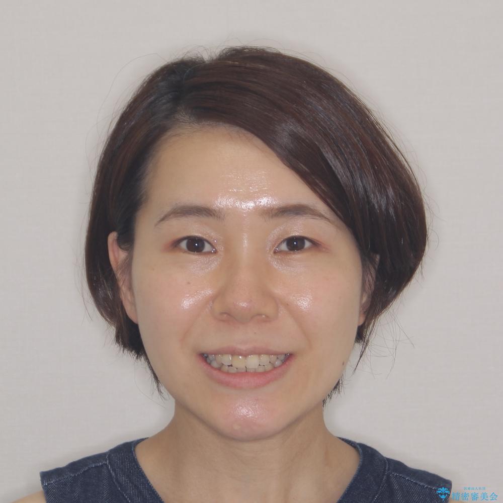 【モニター】後戻りでできた隙間 ワイヤー装置での再矯正の治療前(顔貌)