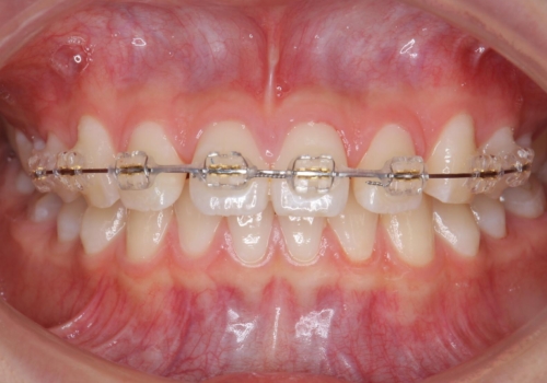 前歯のすき間が気になる 部分矯正での治療中
