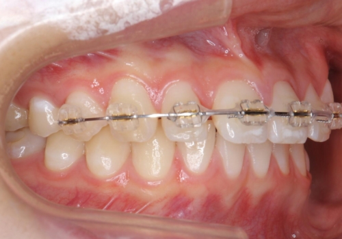 前歯のすき間が気になる 部分矯正での治療中