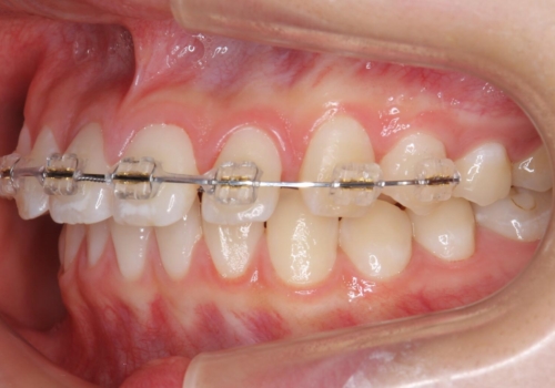 前歯のすき間が気になる　部分矯正での治療中