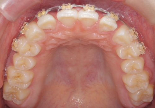 前歯のすき間が気になる　部分矯正での治療中