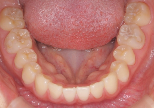 前歯のすき間が気になる 部分矯正での治療中