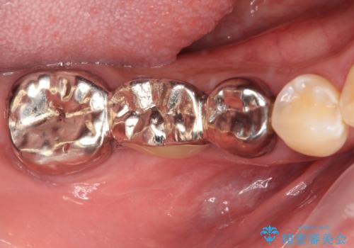 金属のブリッジをやり替えたいの治療前