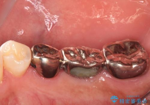 金属のブリッジをやり替えたいの治療前