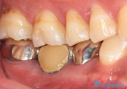金属のブリッジをやり替えたいの治療前