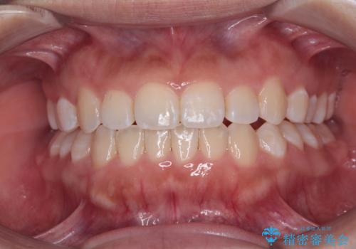 前歯のクロスバイトを改善　インビザライン・モデレートによる矯正治療の治療後