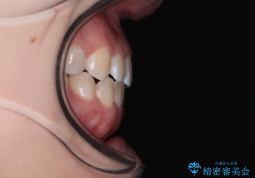 前歯のクロスバイトを改善 インビザライン・モデレートによる矯正治療の治療後