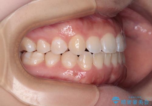 前歯のクロスバイトを改善 インビザライン・モデレートによる矯正治療の治療後