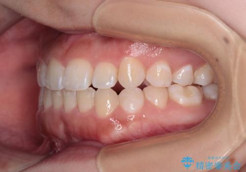 前歯のクロスバイトを改善 インビザライン・モデレートによる矯正治療の治療後