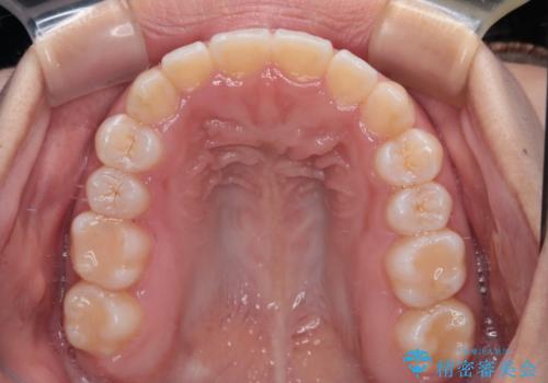 前歯のクロスバイトを改善 インビザライン・モデレートによる矯正治療の治療後