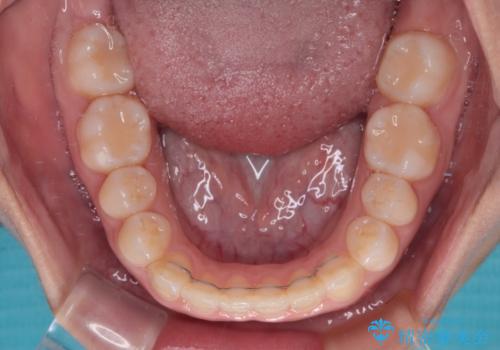 前歯のクロスバイトを改善 インビザライン・モデレートによる矯正治療の治療後