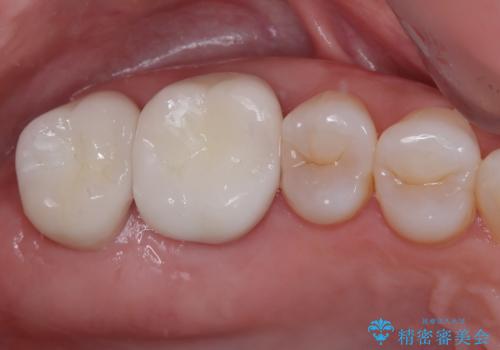 歯周外科処置を併用した奥歯のむし歯治療の治療後