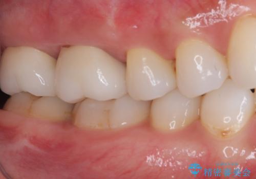歯周外科処置を併用した奥歯のむし歯治療の治療後