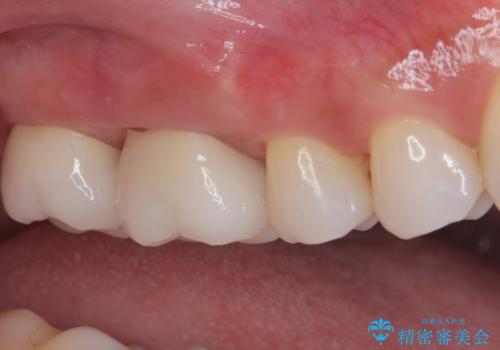 歯周外科処置を併用した奥歯のむし歯治療の治療後