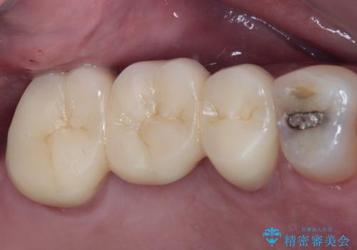 奥歯のブリッジが痛い オールセラミックブリッジでのむし歯治療の症例 治療後