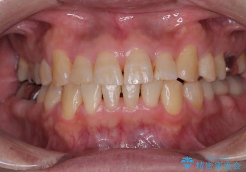 激痛の奥歯のむし歯治療 折角なので矯正治療もしたいの症例 治療後