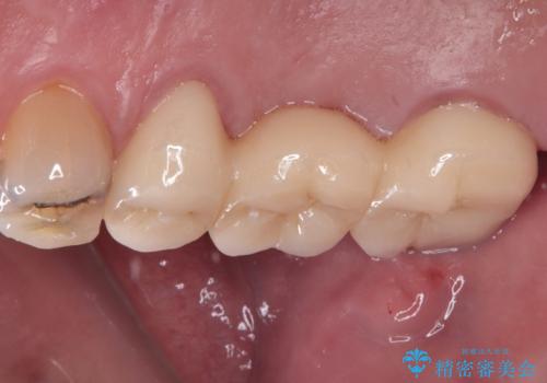 奥歯のブリッジが痛い オールセラミックブリッジでのむし歯治療の治療後
