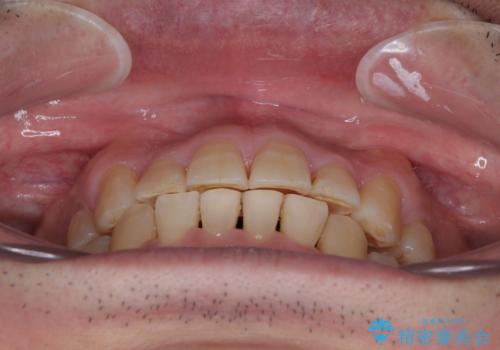 激痛の奥歯のむし歯治療 折角なので矯正治療もしたいの治療後