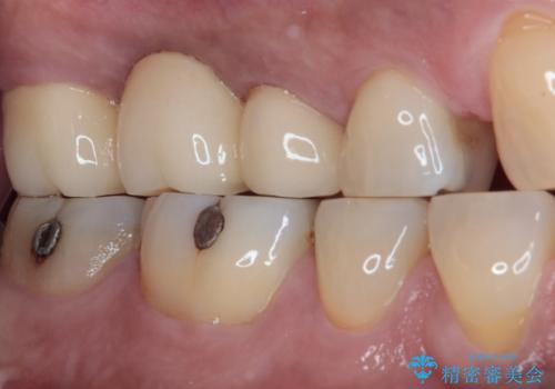 奥歯のブリッジが痛い オールセラミックブリッジでのむし歯治療の治療後