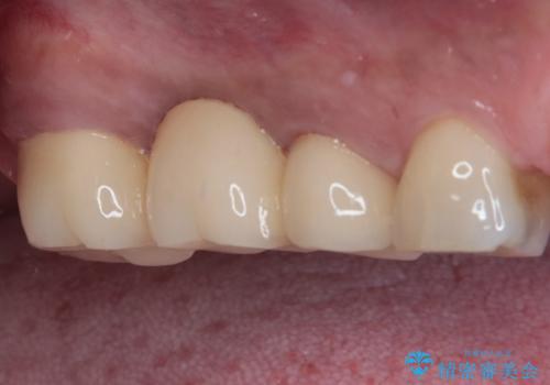 奥歯のブリッジが痛い オールセラミックブリッジでのむし歯治療の治療後