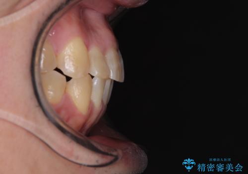 激痛の奥歯のむし歯治療 折角なので矯正治療もしたいの治療後