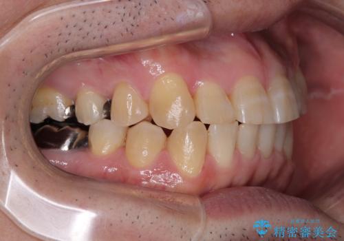 激痛の奥歯のむし歯治療 折角なので矯正治療もしたいの治療後