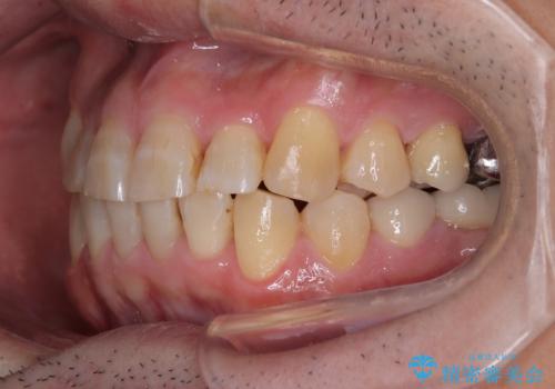 激痛の奥歯のむし歯治療 折角なので矯正治療もしたいの治療後