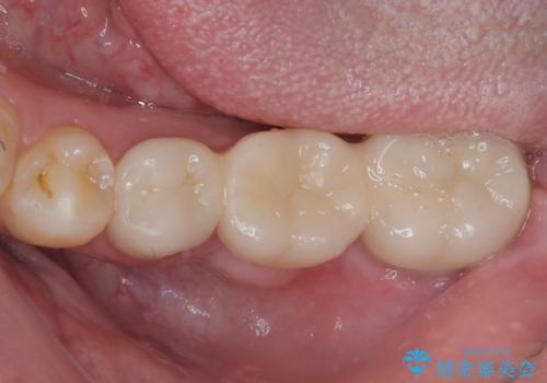 激痛の奥歯のむし歯治療 折角なので矯正治療もしたいの治療後