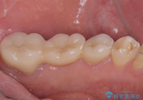 激痛の奥歯のむし歯治療 折角なので矯正治療もしたいの治療後