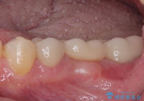 激痛の奥歯のむし歯治療 折角なので矯正治療もしたいの治療後