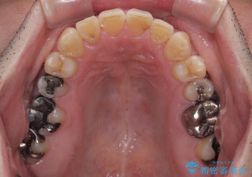 激痛の奥歯のむし歯治療 折角なので矯正治療もしたいの治療後