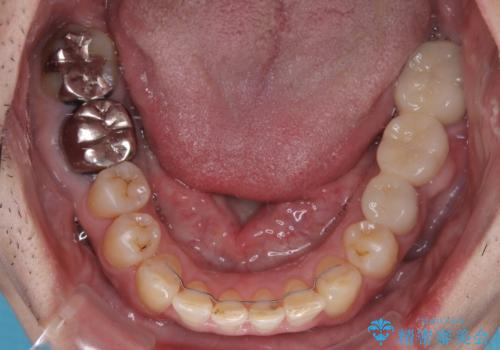 激痛の奥歯のむし歯治療 折角なので矯正治療もしたいの治療後