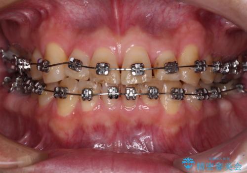 激痛の奥歯のむし歯治療 折角なので矯正治療もしたいの治療中