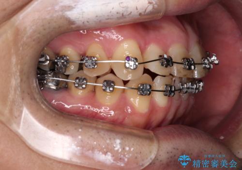 激痛の奥歯のむし歯治療 折角なので矯正治療もしたいの治療中